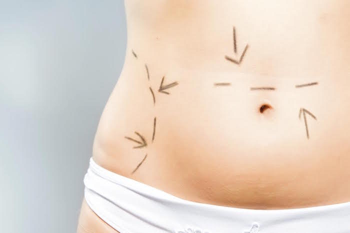 Tummy Tuck or Liposuction: Which Cosmetic Procedure Is Right for You?